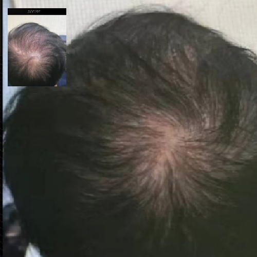 髮際線精雕術課程